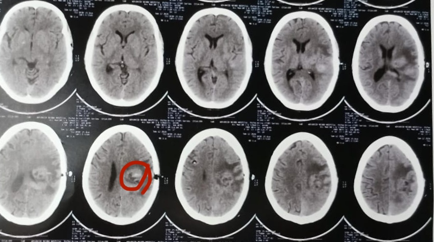 Neuro-Navigation Guided Stereotactic Brain Biopsy