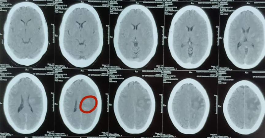 Neuro-Navigation Guided Stereotactic Brain Biopsy