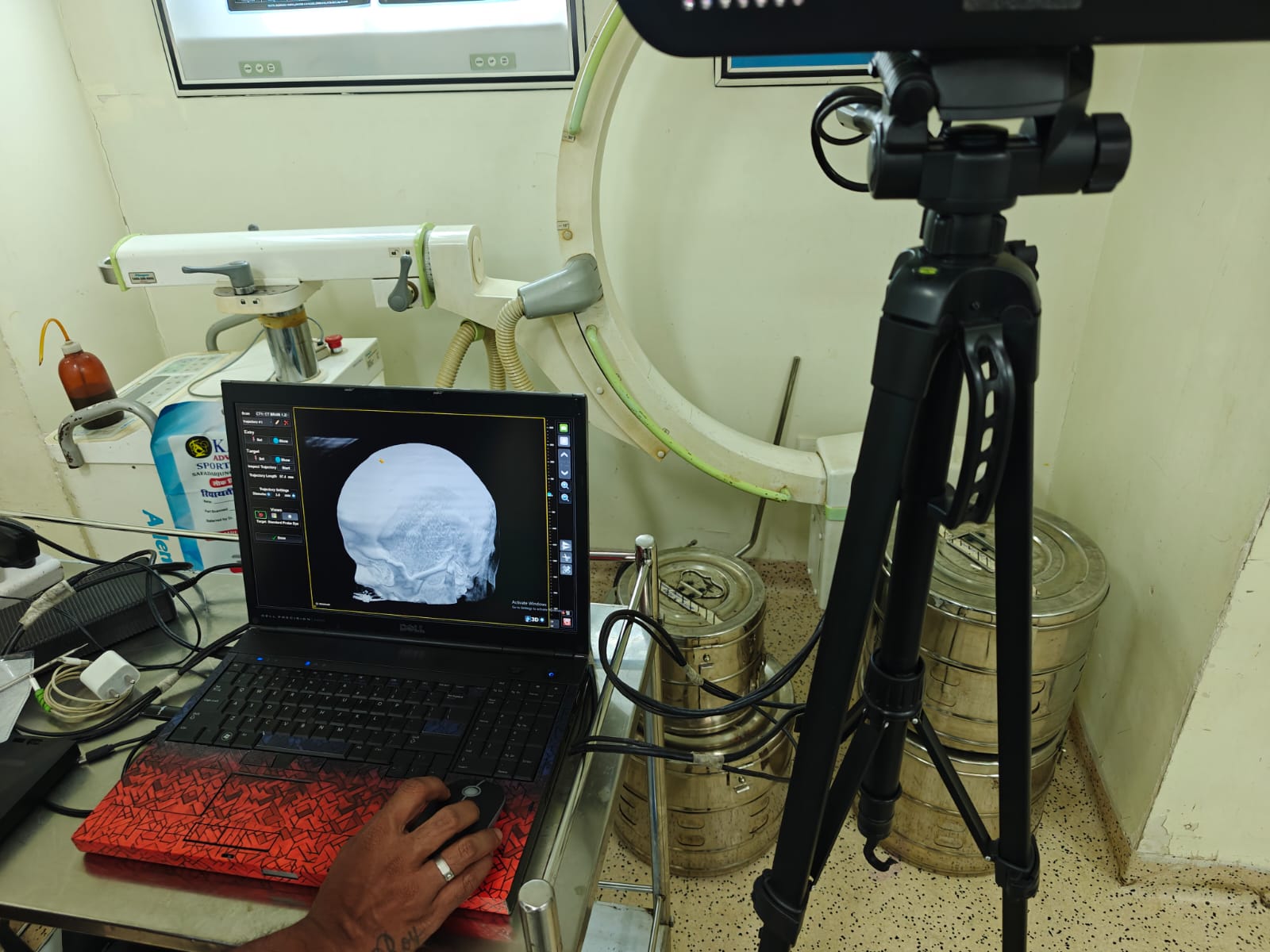 Neuro-Navigation Guided Stereotactic Brain Biopsy